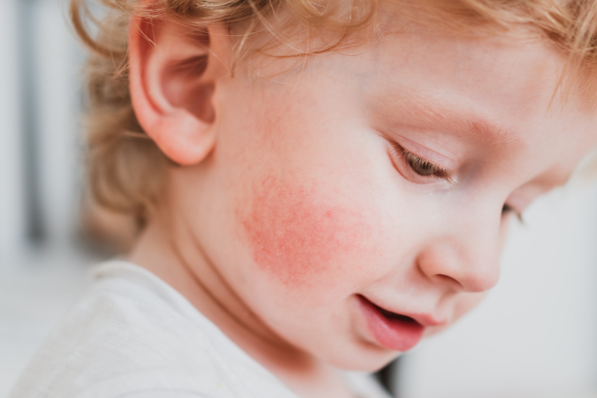 food allergies, eczema, or diathesis in a small child on the cheeks